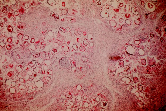m101-3-Absidia-corymbifera-in-a-transplantable-tumor-of-the-mouse-Emmons